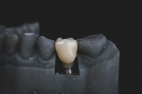 Dental implants artificial tooth and crown showing how it is situated in the jaw of a person