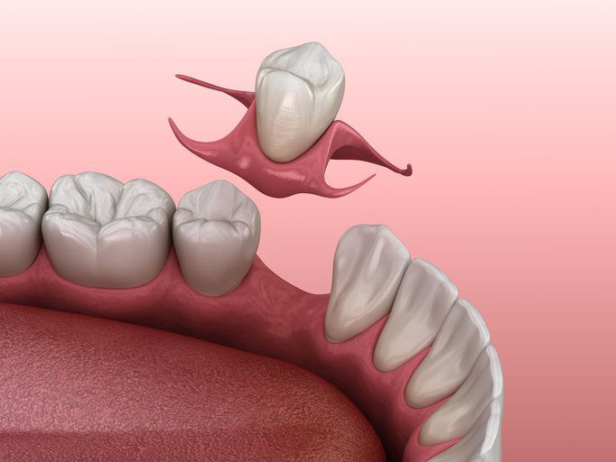 1 TOOTH DENTURE