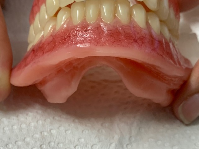 Vertex softbase on denture
